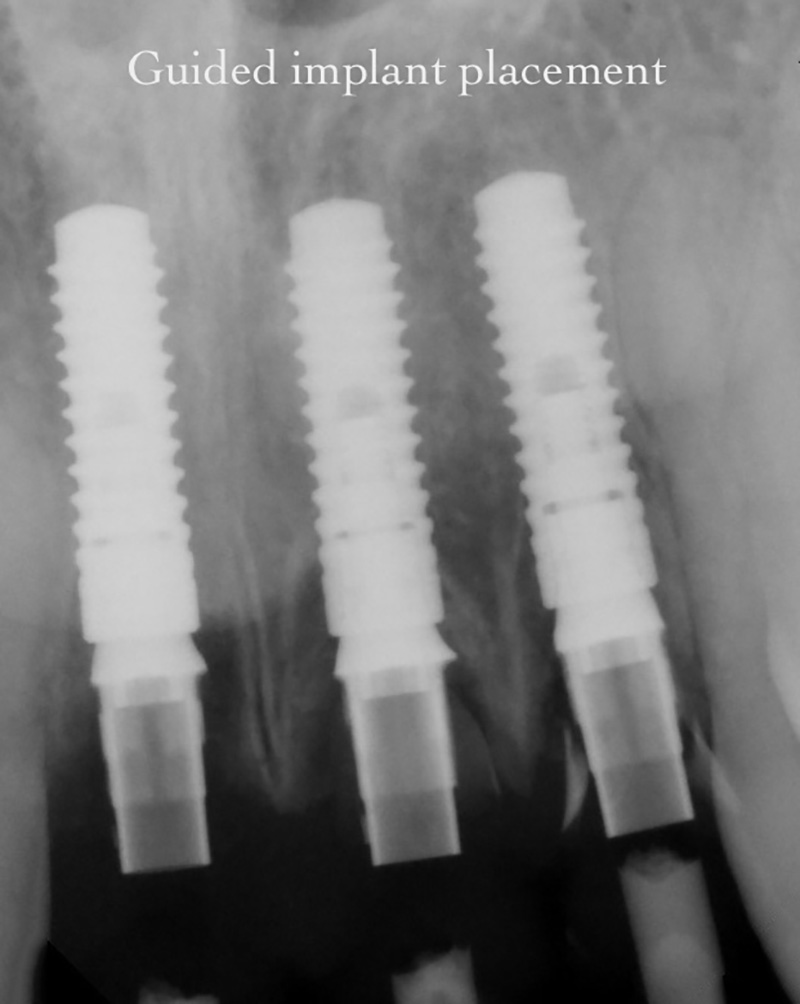 Dental implants placed