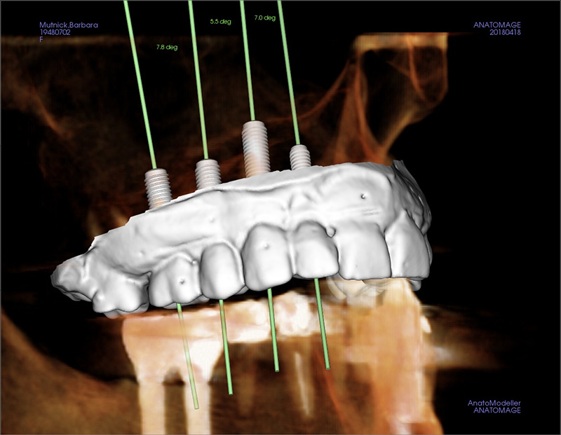 Virtual planning of dental implant position