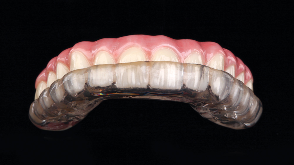 Hard occlusal guard to help bruxism