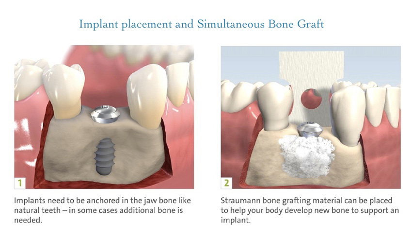 Implant with simultaneous bone graft