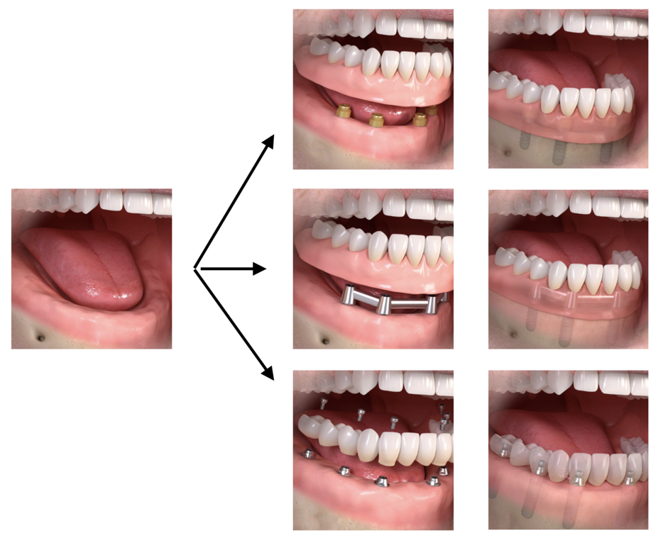 Tooth replacement options at Portland Perio Implant Center