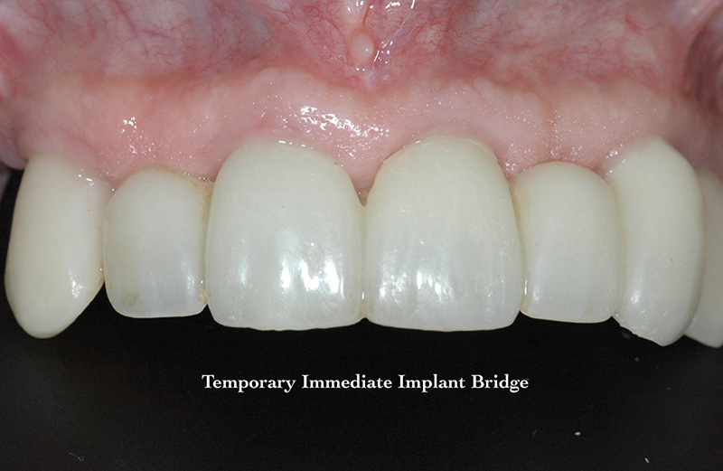 Temporary immediate implant bridge