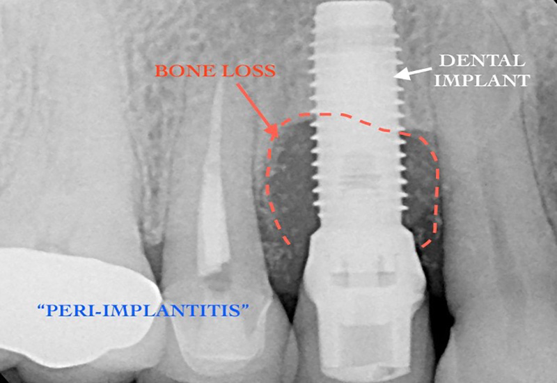 X-ray showng bone loss around a dental implant