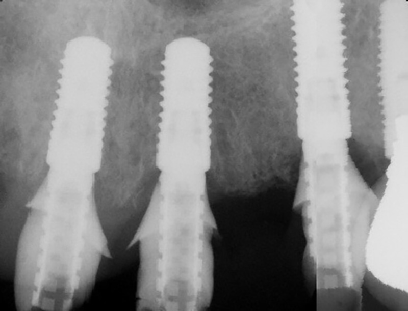 X-ray of implants to support bridge