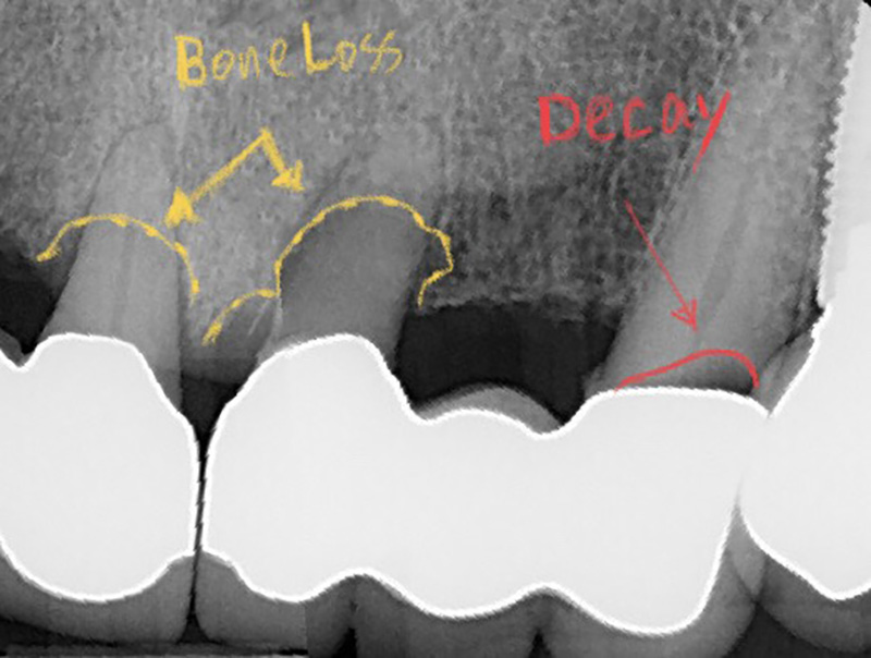 X-ray of bone loss and tooth decay