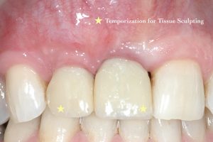 Implant Treatment for Tooth loss from periodontal disease at Portland Perio Implant Center