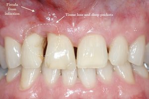 Implant Treatment for Tooth loss from periodontal disease at Portland Perio Implant Center