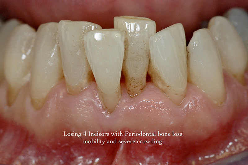 Losing 4 incisors with periodontal bone loss, mobility & severe crowding