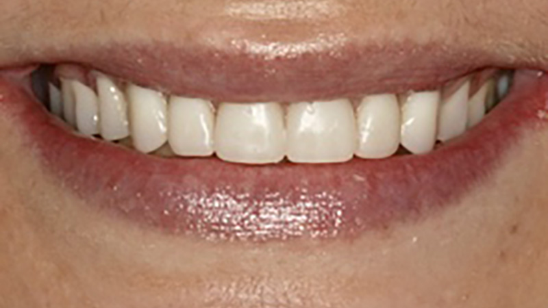 Full mouth dental implants, smile in a day