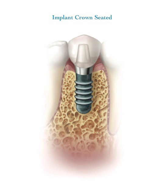 Dental implant, abutment and crown placed