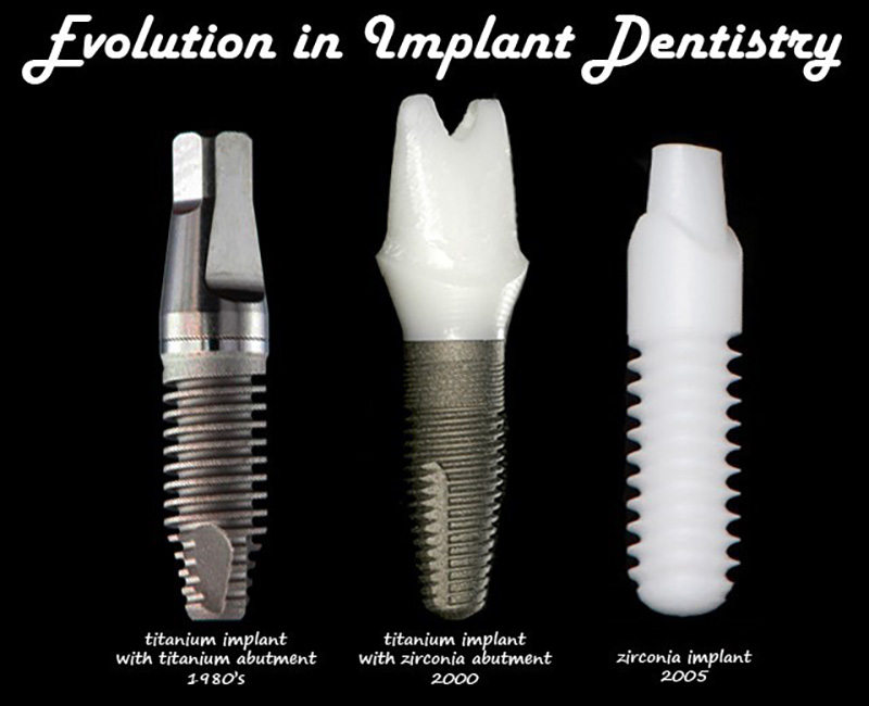 Evolution of implant dentistry