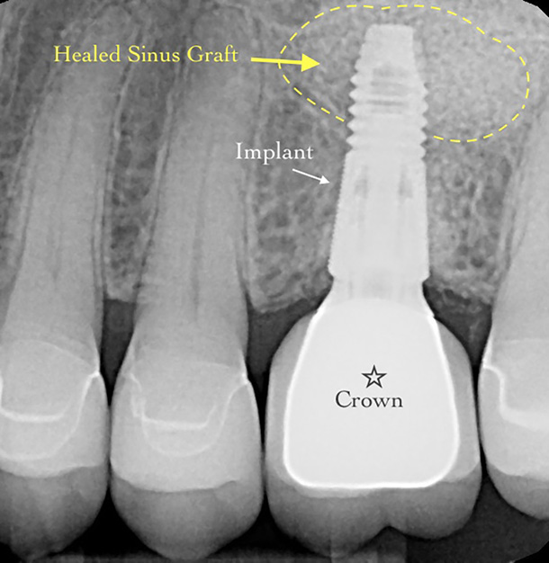X-ray of healed sinus graft