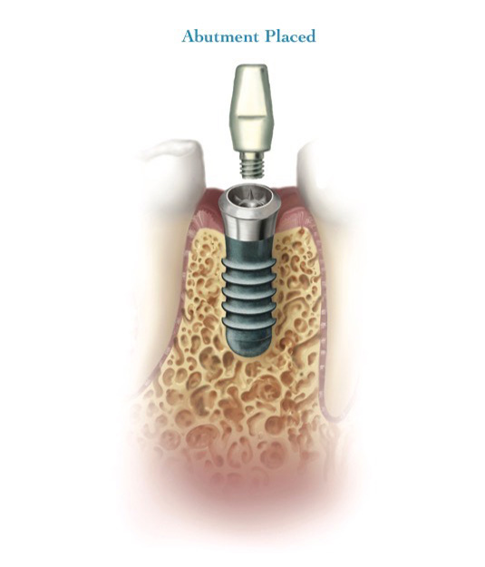 Dental implant and abutment placed in the bone