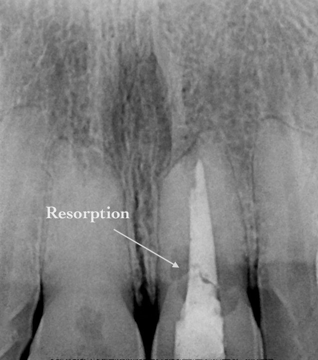 X-ray showing tooth root resorption