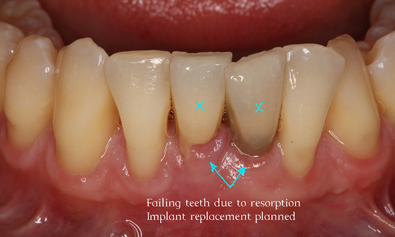 Failing teeth due to resorption