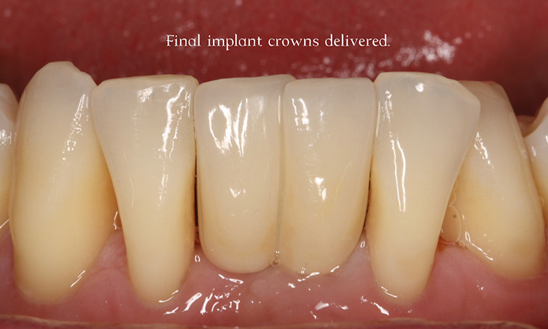 Final implant crowns in place