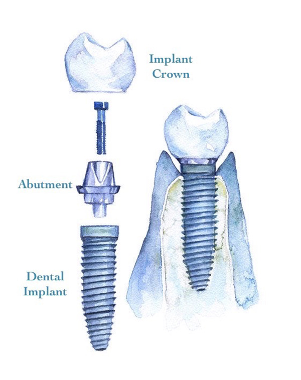 Dental implant with abutment and implant crown