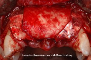 Case Study Kelli - Bone Grafting and Implants - 4