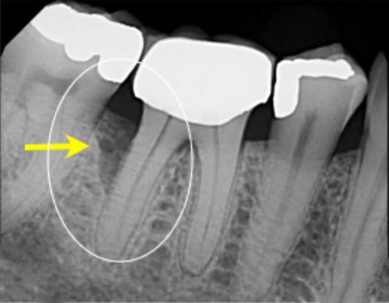 Periodontal Regeneration Portland Perio Implant Center