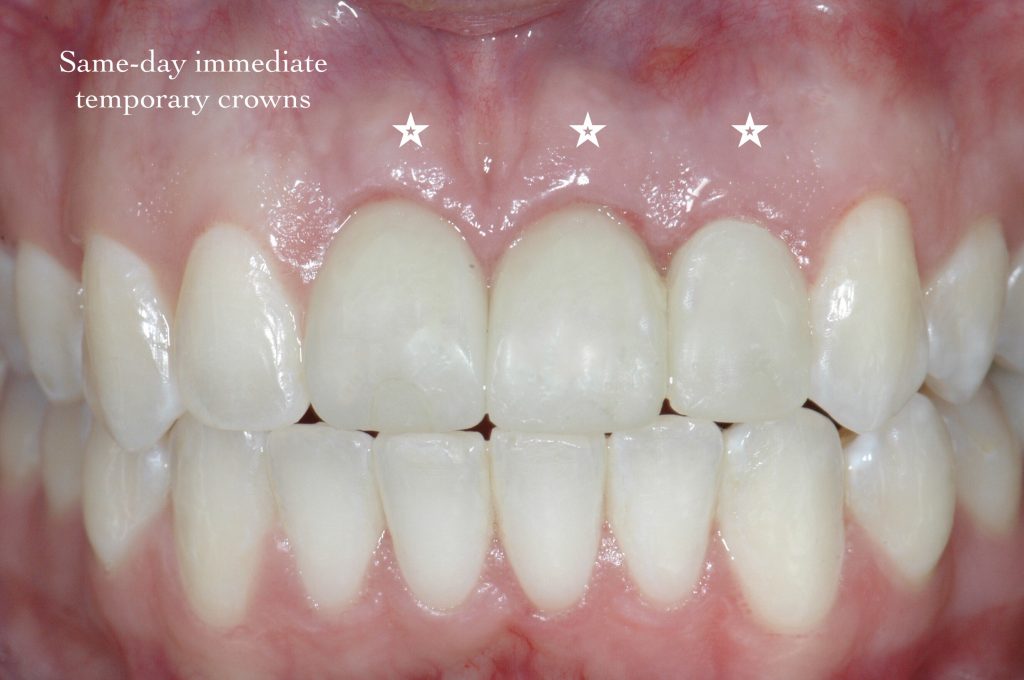 Same day immediate temporary crowns