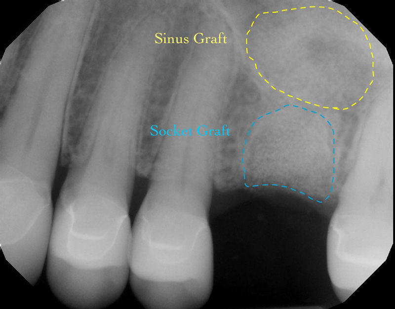 X-ray of sinus graft and socket graft