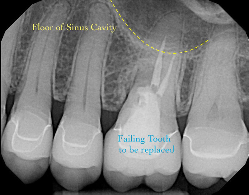X-ray of failing tooth to be replaced