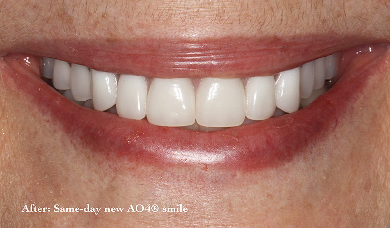 All-On-4 dental implants patient after treatment
