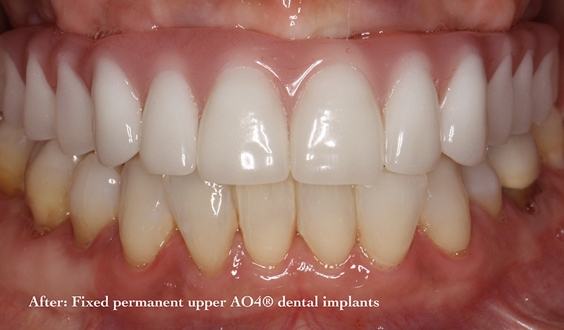 All-On-4 dental Implants patient after treatment