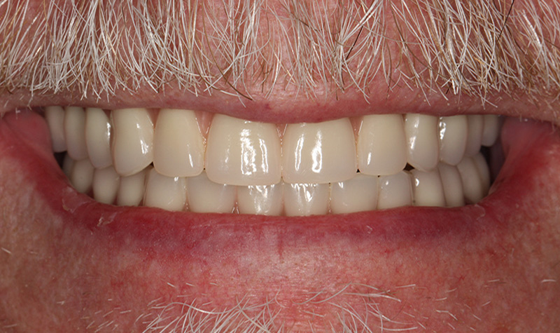 All-On-4 dental implants patient after treatment
