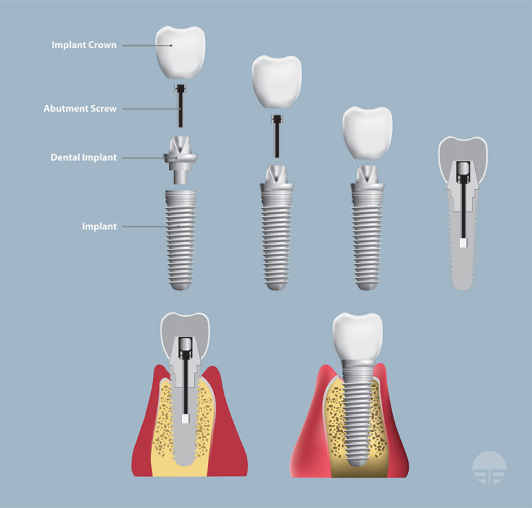 All On 4 Dental Implants - Portland Perio Implant Center