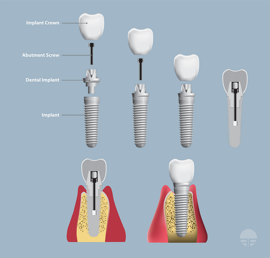Retaining Screw illustration for dental implants