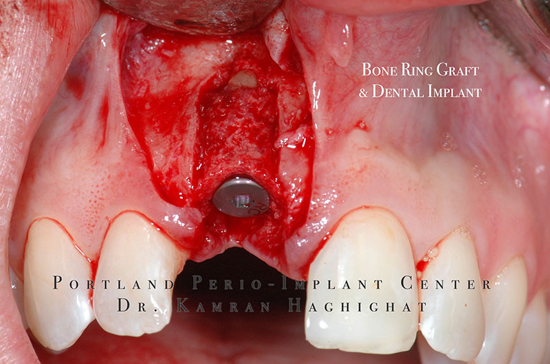 Bone Ring graft and dental implant