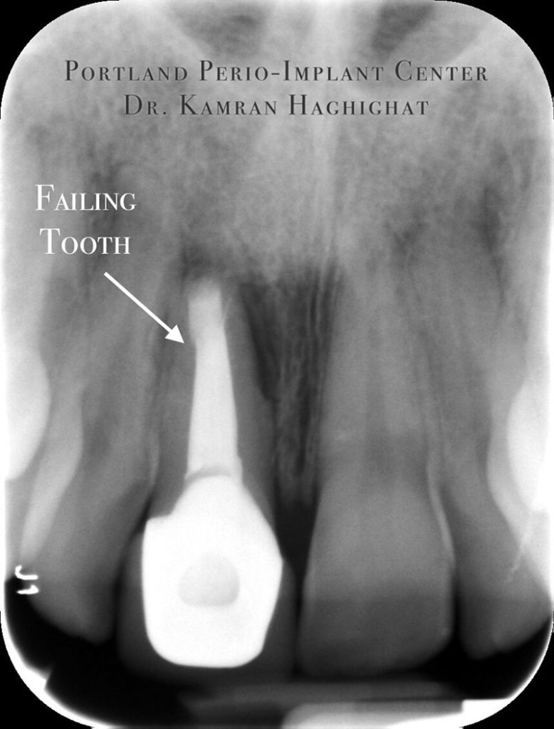 Failing tooth scan at Portland Perio Implant Center