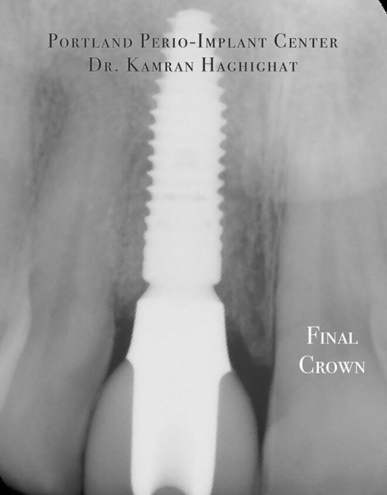 Bone Ring Procedure Lori Portland Perio Implant Center