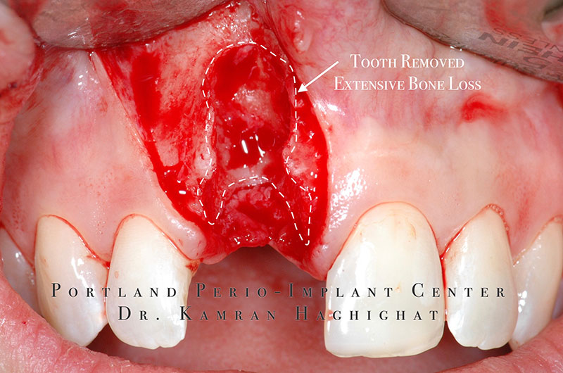 Tooth removed patient having extensive bone loss at the site