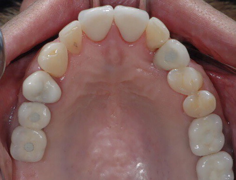Upper teeth after treatment