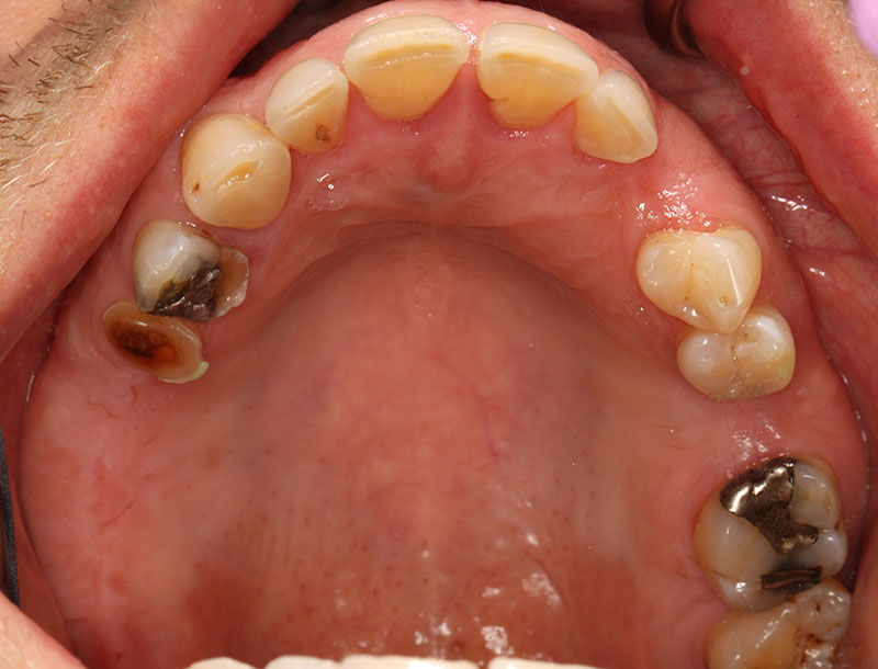 Upper teeth before treatment