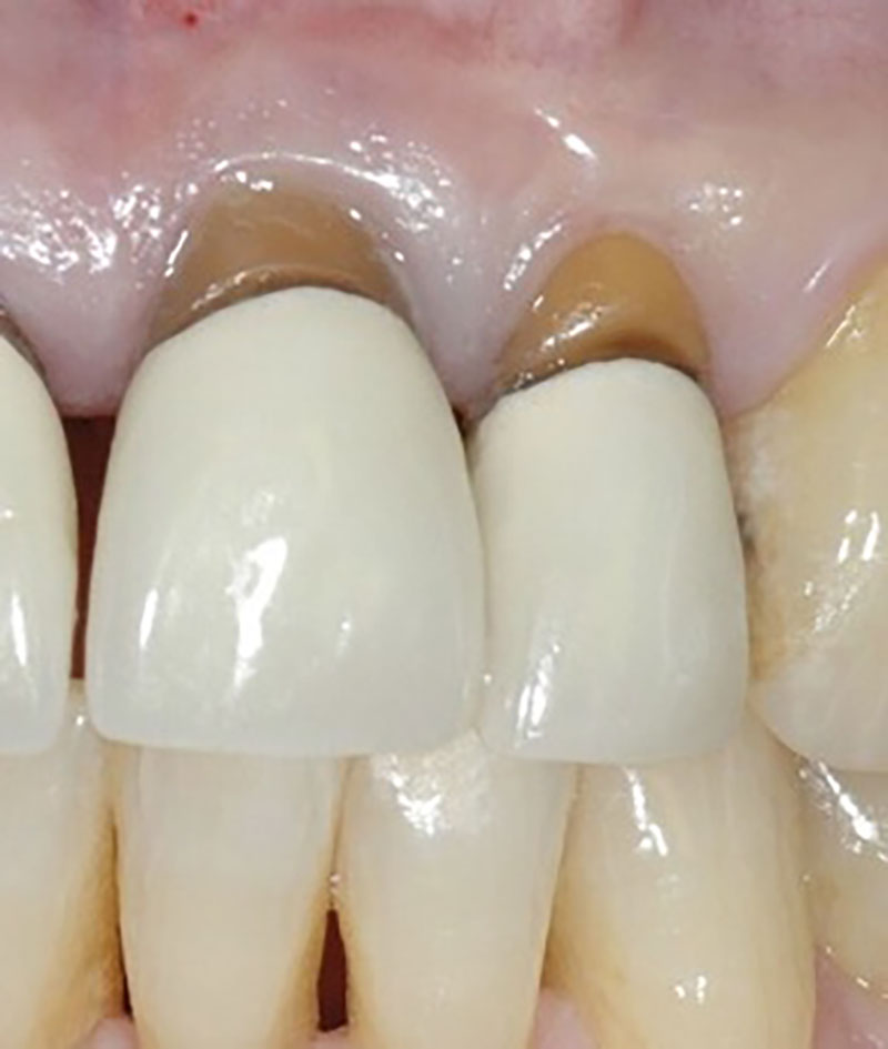 Teeth before dental implant treatment