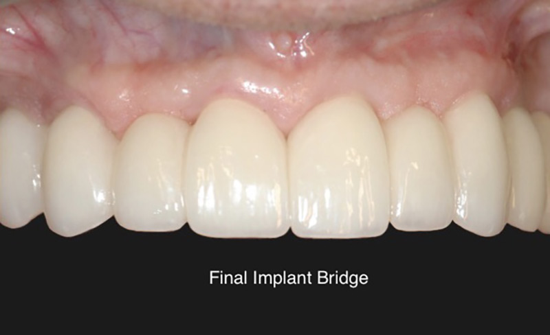 FInal implant bridge for patient of Portlant Perio Implant Center