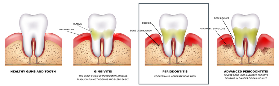 Periodontitis illustration