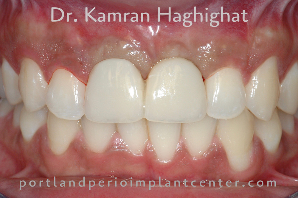 Immediate temporary crowns for both front teeth