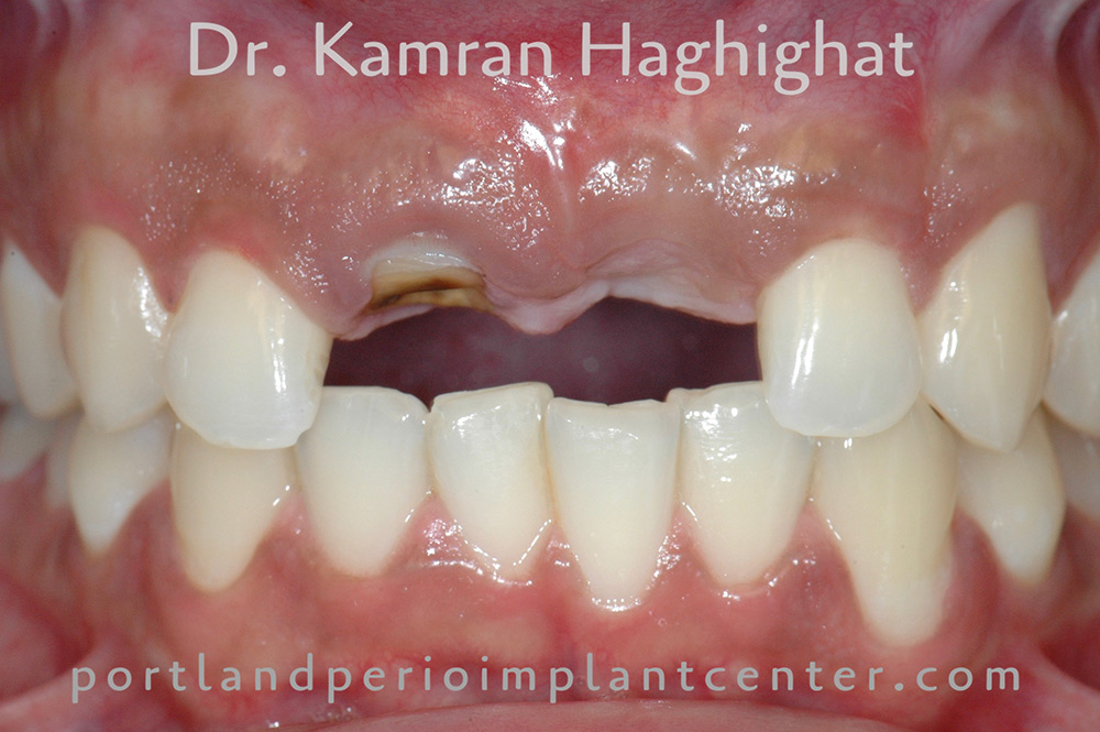 Same-day dental implants and temporary crowns