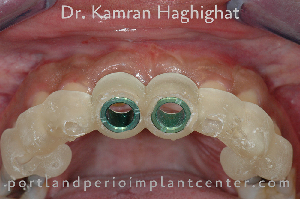 During dental implant surgery