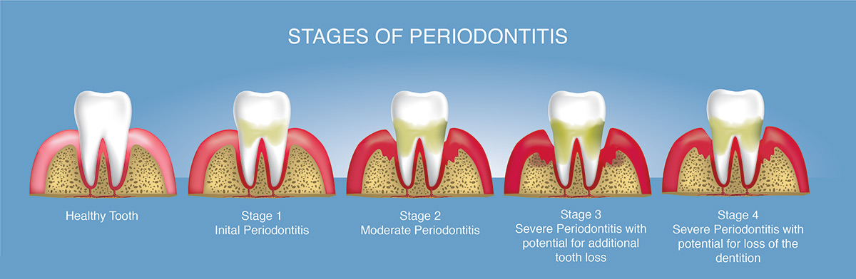 Stages of Periodontitis - what is periodontitis