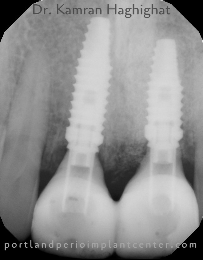 X-ray after implants