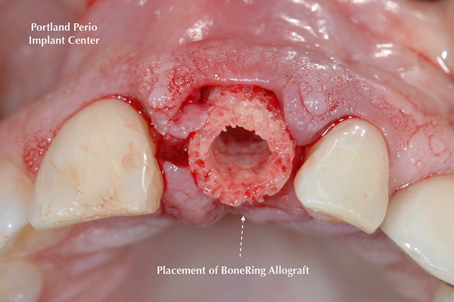 Front tooth restoration using allograft bone ring method at Portland Perio Implant Center.