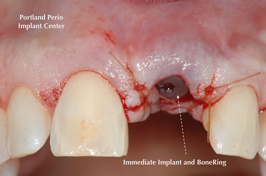 Front tooth restoration using allograft bone ring method at Portland Perio Implant Center.