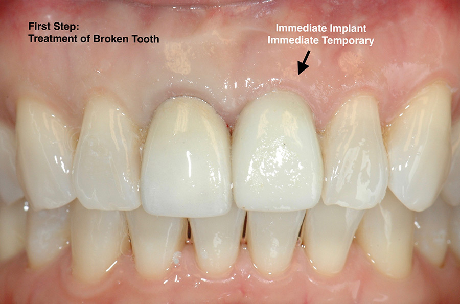 Immediate implant and temporary front tooth.