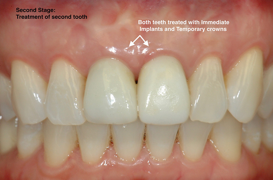 Dental implant treatment for second broken front tooth.
