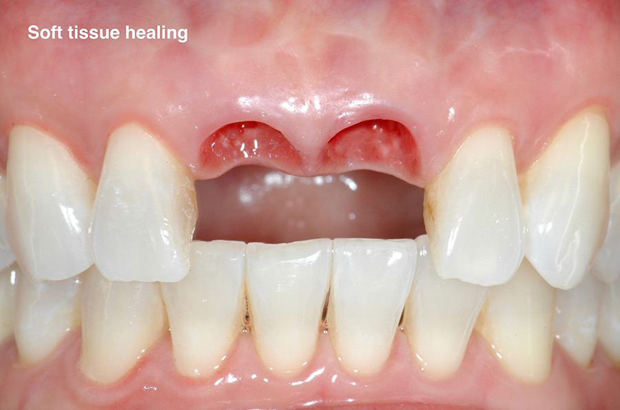 Front tooth soft tissue healing after dental implants.